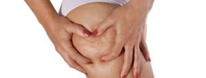 acido-polilattico-cellulite