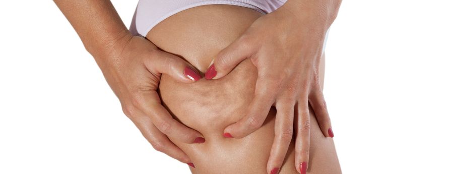 acido-polilattico-cellulite